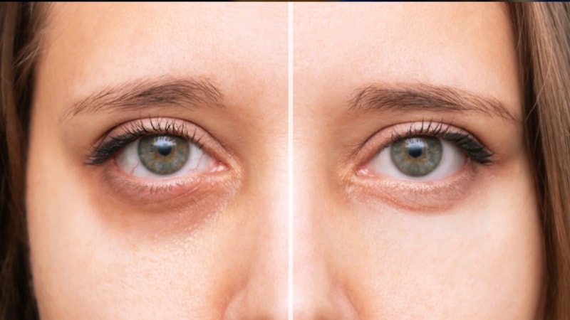 Göz altı morluklarını 1 günde yok eden formül: Dondurup sürmek şart…