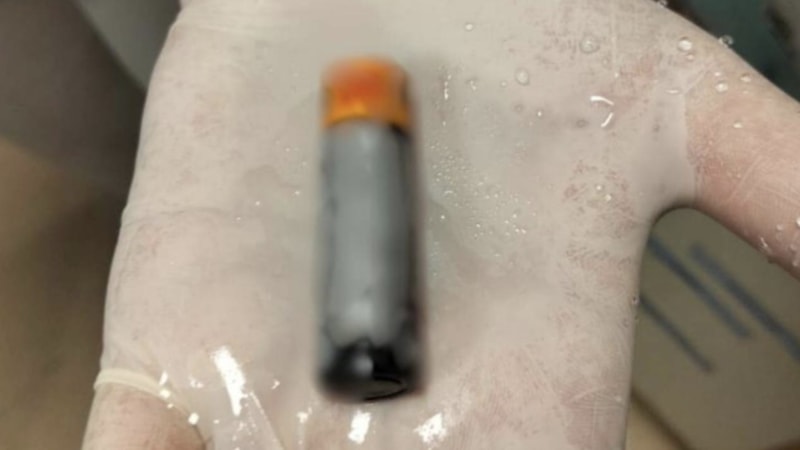 Denizli'de yuttuğu pil operasyonla alınan hasta sağlığına kavuştu