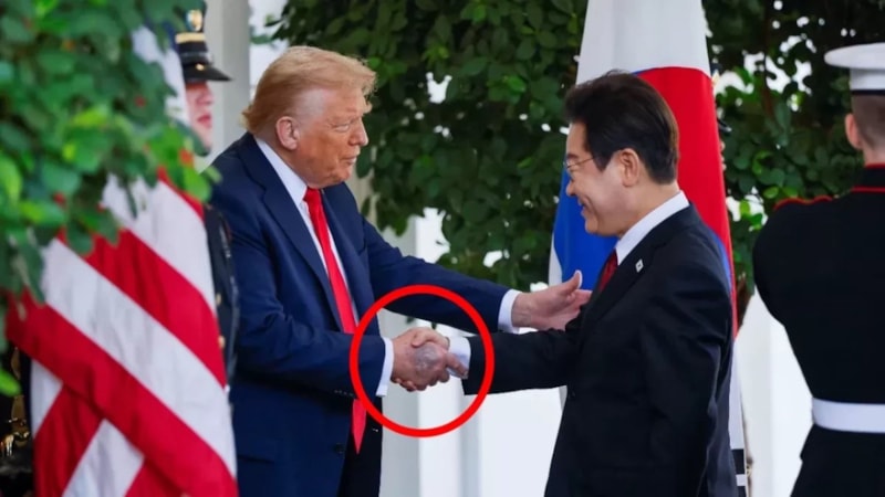 Donald Trump'ın eli neden morardı? İşte sebebi