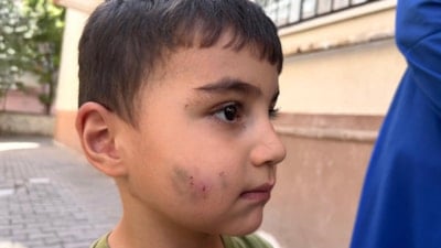 Ankara'da evde uyuyan çocuğu lağım faresi ısırdı