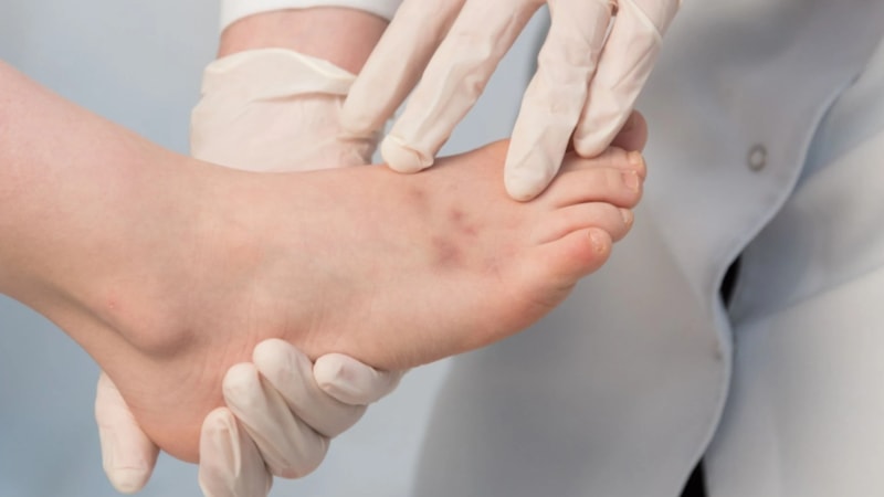 Ayaklarda morarma neden olur? Ayaklarda morarma için hangi doktora gidilir?