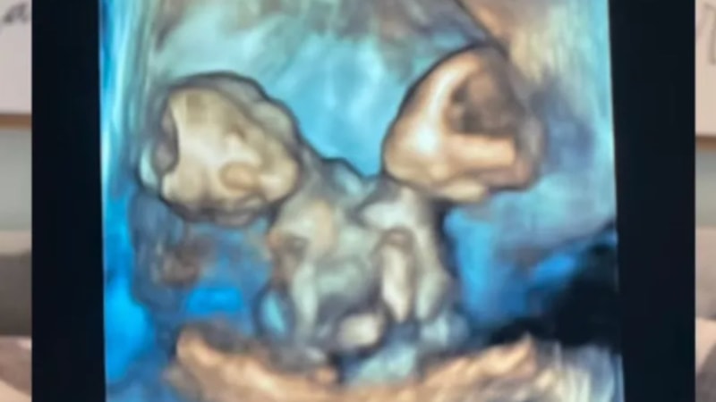 ABD'de bir anne zor olanı seçti: Yapışık ikizler doğar doğmaz hayata veda ettiler