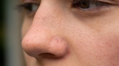 Burun kıllarınızı koparmayın: Menenjite davetiye çıkarıyor