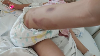 İzmir'de 3 yaşındaki Yaren şifa bulmak için girdiği ameliyattan yanık izleriyle çıktı