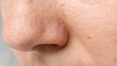 Burun tıkanıklığı kabus olmasın: 4 pratik yöntemle kurtulun