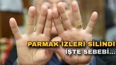 Parmaklarında iz kalmadı: Sebebi şaşırttı