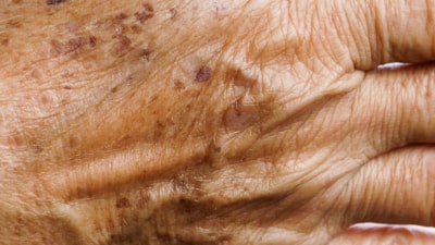 Günde 1 kez sürün, yaşlılık lekelerini götürün...