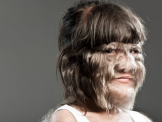 Nadir hastalıklara yüksek teknoloji umudu