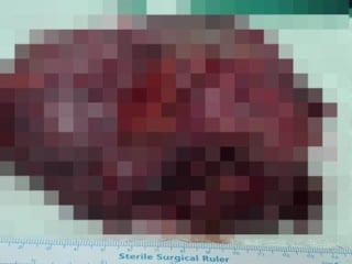 Şanlıurfa’da karın boşluğundan 25 santimlik dev kist çıktı