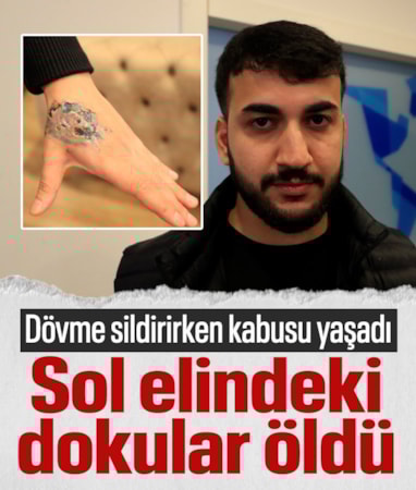 Antalya'da dövme sildirmek isterken elindeki dokuları kaybetti