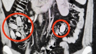 Eskişehir'de midesinde uyuşturucu bulunan şüpheli tutuklandı