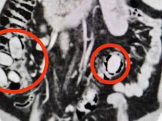 Eskişehir'de midesinde uyuşturucu bulunan şüpheli tutuklandı