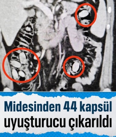 Eskişehir'de midesinde uyuşturucu bulunan şüpheli tutuklandı