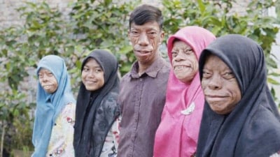 Farklı doğdular, fenomen oldular: Kertenkele Ailesi'nin hikayesi