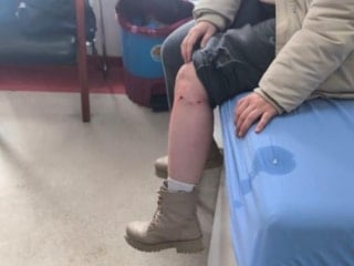 Kayseri'de sokak köpeğinin saldırdığı çocuk yaralandı