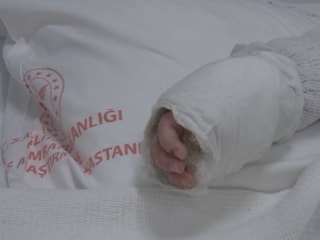 İstanbul'da bebeğin üzerine kaynar su döküldü: Vücudunun yüzde 27'si yandı