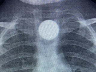 Bursa'da 3 yaşındaki Bilal’in yuttuğu madeni para, yemek borusunda kaldı