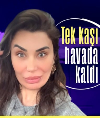 Ebru Şancı botoksu fazla kaçtı
