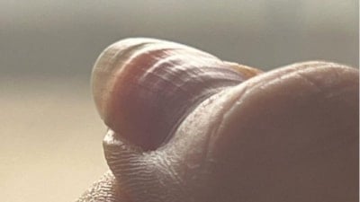 Dalgalı tırnak bakın neyin habercisi! Vücut böyle alarm veriyor...