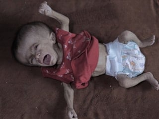 Gazze'de açlık: Filistinli bebeğin yaşam mücadelesi