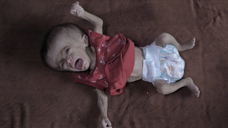 Gazze'de açlık: Filistinli bebeğin yaşam mücadelesi