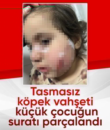 İzmir'de tasmasız köpek saldırısı: Küçük çocuk yüzünden ısırıldı