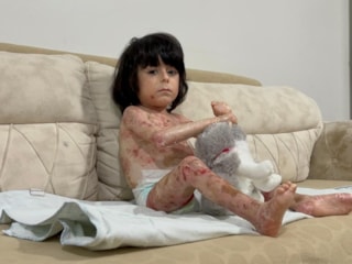 Bursa’da 4 yaşındaki İbrahim’in 'kelebek hastalığı' hayatını zorlaştırıyor