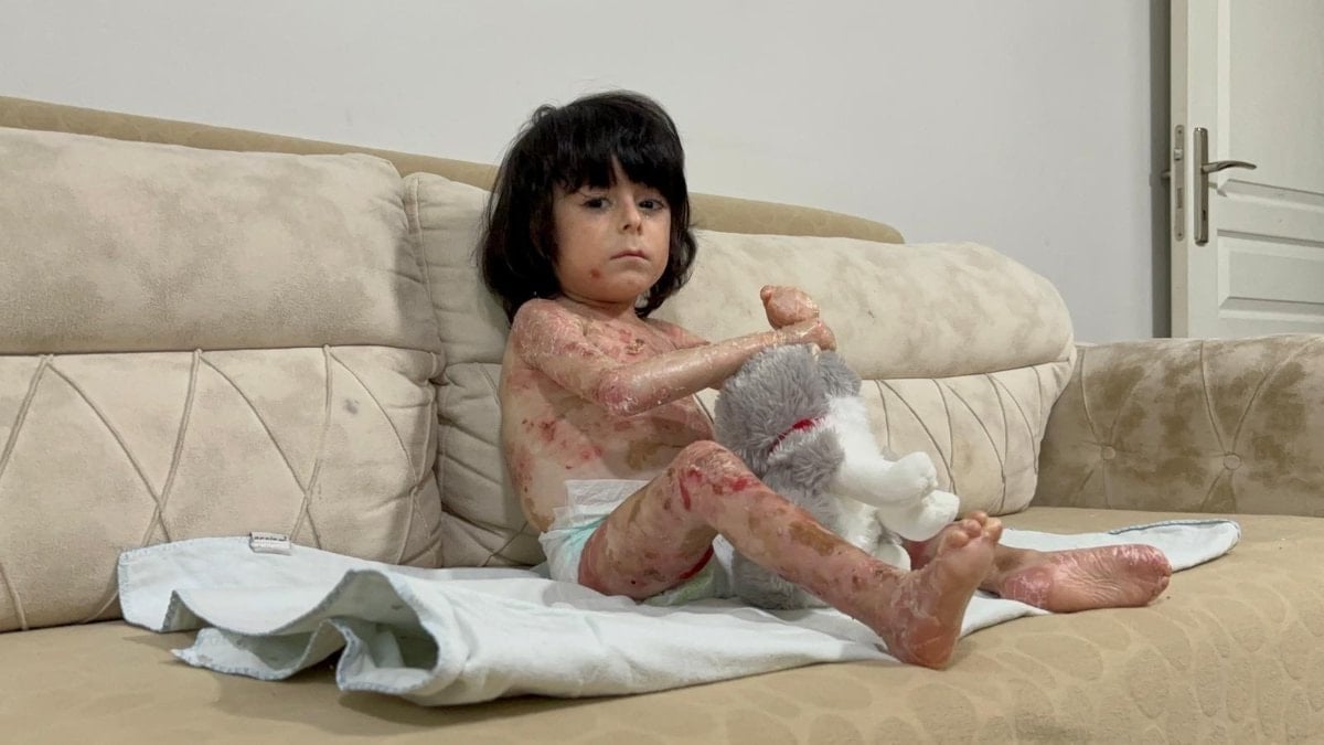 Bursa’da 4 yaşındaki İbrahim’in 'kelebek hastalığı' hayatını zorlaştırıyor