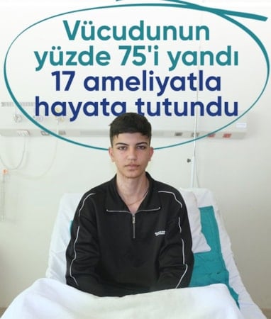 Kahramanmaraş'ta yüzde 75 yanıklı genç, 17 ameliyatla sağlığına kavuştu