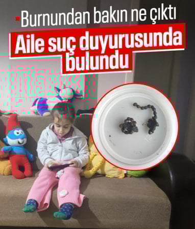 Rize'de 5 yaşındaki çocuğun burnundan tırnak makası zinciri çıktı