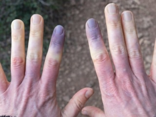 Üşüdüm sanmayın: Eğer teninize mavilik varsa...