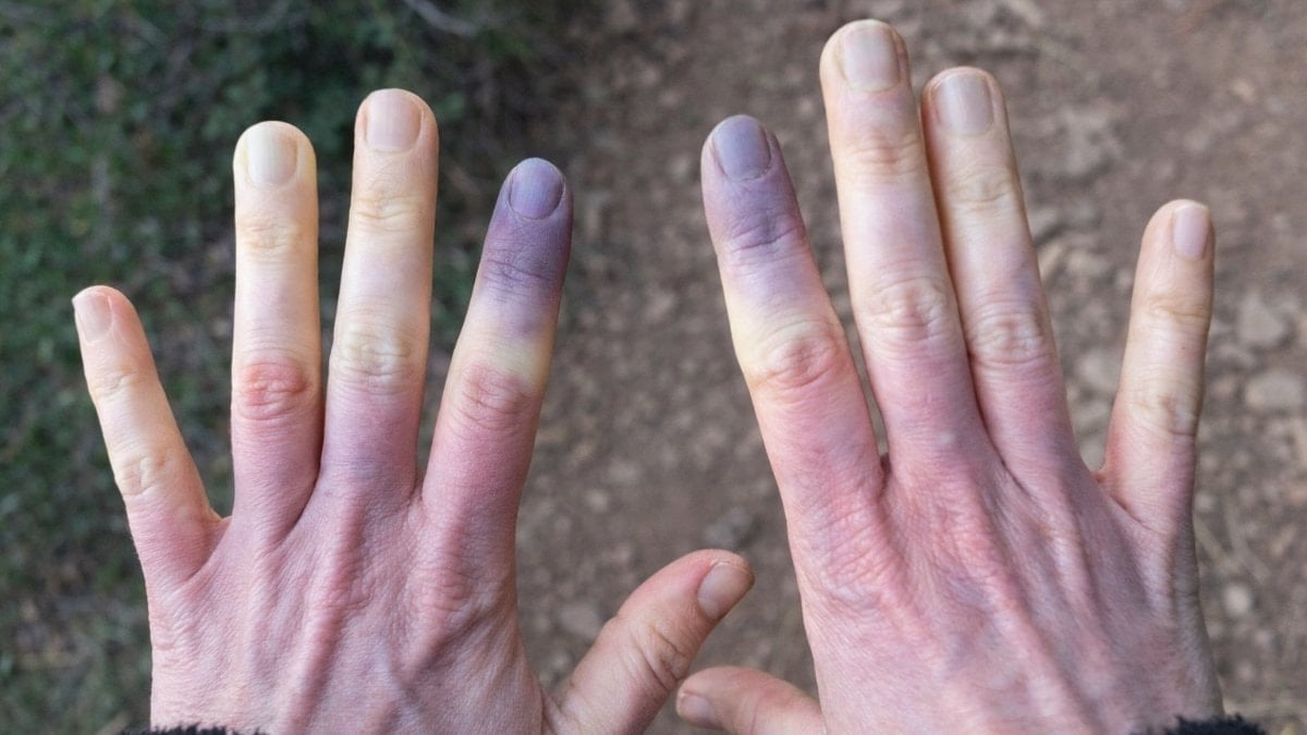 Üşüdüm sanmayın: Eğer teninize mavilik varsa...