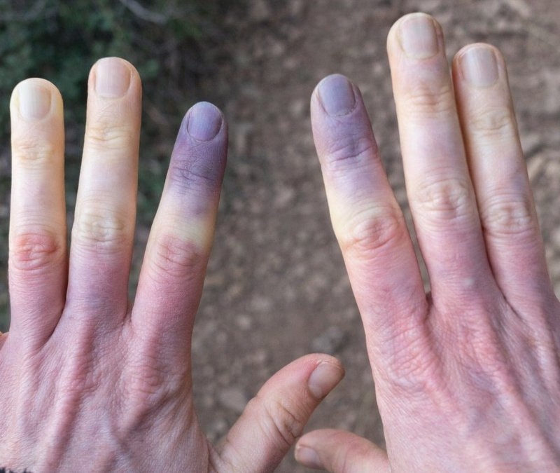 Üşüdüm sanmayın: Eğer teninize mavilik varsa...