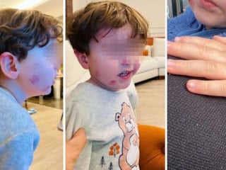 Bursa'da kreşe sağlam giren çocuk, akşam darbedilmiş halde çıktı