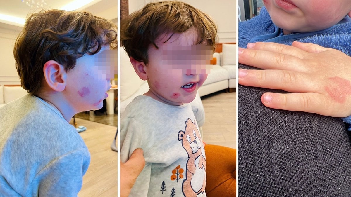 Bursa'da kreşe sağlam giren çocuk, akşam darbedilmiş halde çıktı