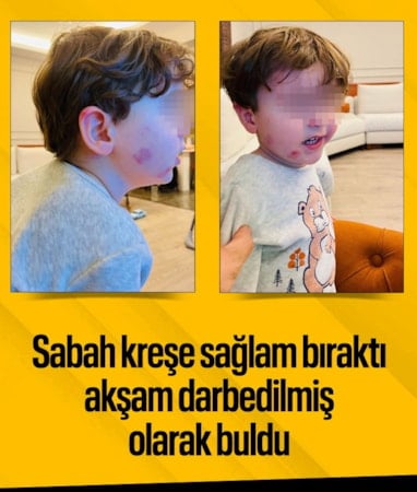 Bursa'da kreşe sağlam giren çocuk, akşam darbedilmiş halde çıktı
