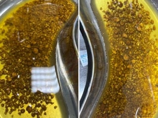 Bingöl'de hastanın ameliyatında 2 bin 67 taş çıkarıldı