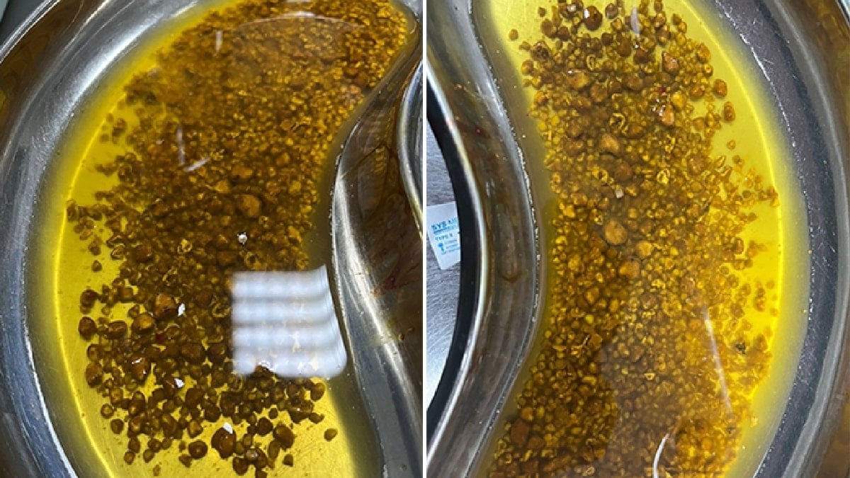 Bingöl'de hastanın ameliyatında 2 bin 67 taş çıkarıldı