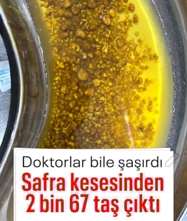 Bingöl'de hastanın ameliyatında 2 bin 67 taş çıkarıldı