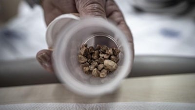 Erzurum'da bir kadının idrar kanalından 51 taş çıkarıldı