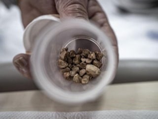 Erzurum'da bir kadının idrar kanalından 51 taş çıkarıldı