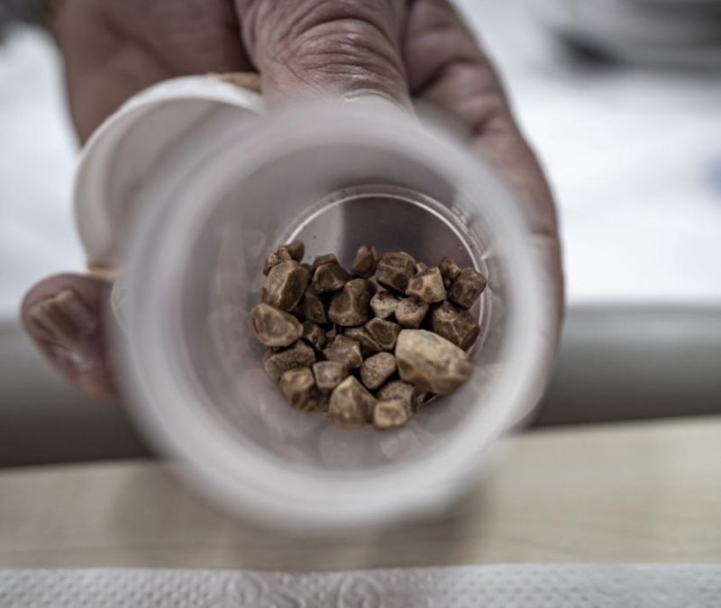 Erzurum'da bir kadının idrar kanalından 51 taş çıkarıldı