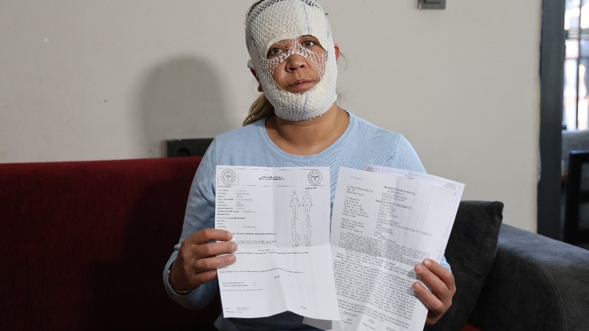 Adana'da güzelleşmek umuduyla işlem yaptırdı: Suratı yandı