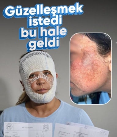 Adana'da güzelleşmek umuduyla işlem yaptırdı: Suratı yandı