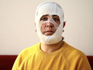 Adana'da cilt bakımı sonrası yüzünde yanık oluştu: İşletmeden şikayetçi oldu