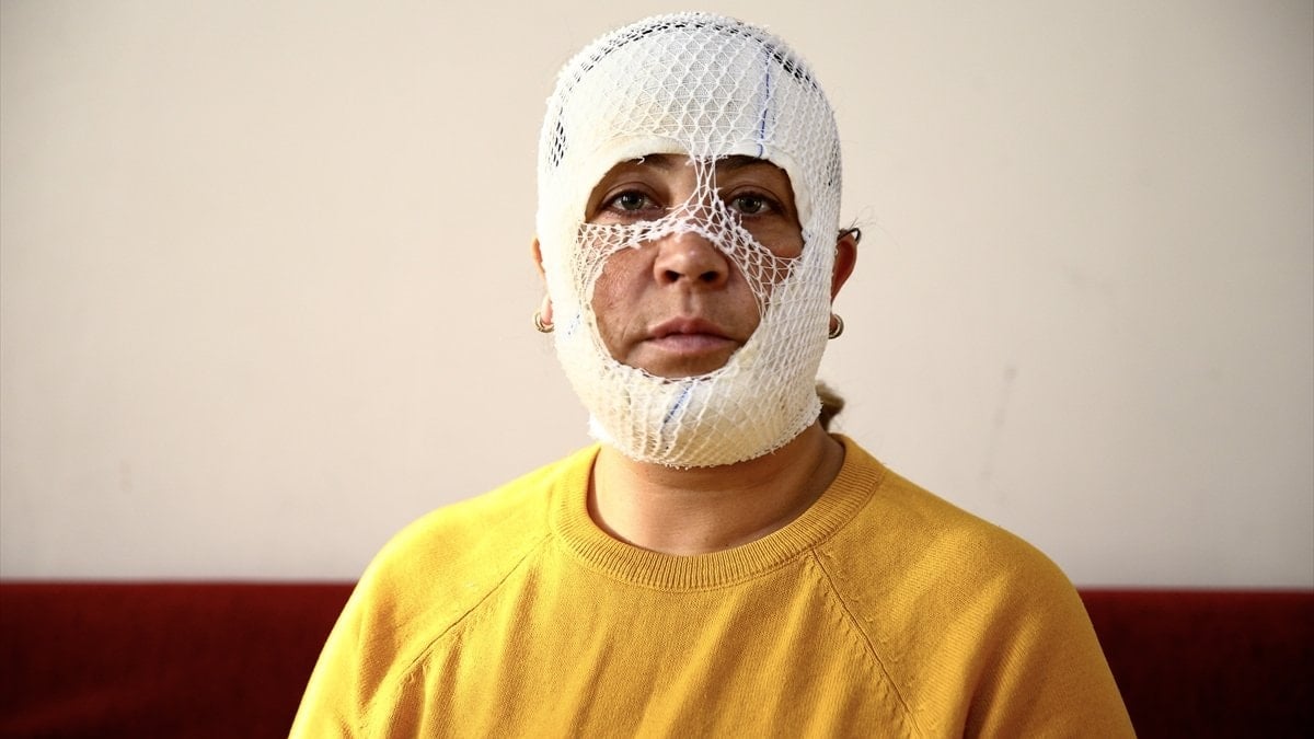 Adana'da cilt bakımı sonrası yüzünde yanık oluştu: İşletmeden şikayetçi oldu