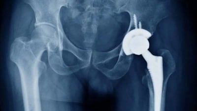 Kastamonu Üniversitesi’nde kalça protezi ameliyatlarını kolaylaştıran alet tescillendi