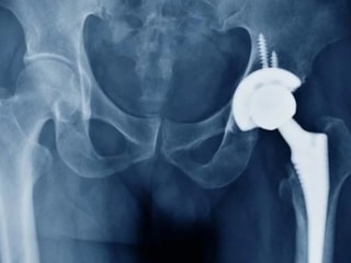 Kastamonu Üniversitesi’nde kalça protezi ameliyatlarını kolaylaştıran alet tescillendi