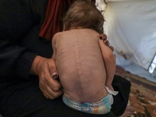 Gazze'de çocuklar hem açlık hem de hastalıkla mücadele ediyor