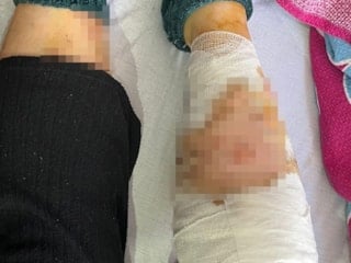 Ankara’da köpek sürüsü saldırısı: Yaşlı kadın ağır yaralandı